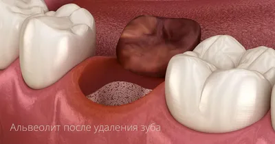 Альвеолит лунки после удаления зуба [лечение и симптомы]