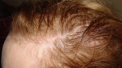 Лечение выпадения волос у мужчин в Москве: цены, фото до и после, отзывы |  Стоимость лечения выпадения волос у мужчин в клинике Seline
