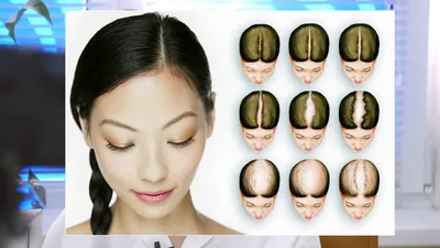 Выпадение волос (алопеция): что это, симптомы и лечение | Статьи МедЭксперт