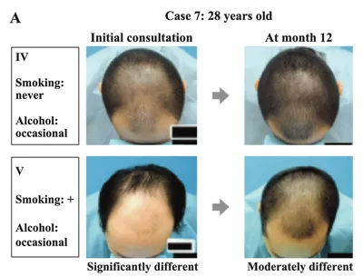 Лечение андрогенной алопеции у мужчин и женщин без пересадки волос!! —  Клиника Perfecto-Room в Киеве