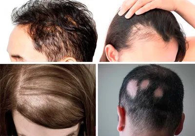 Выпадение волос (алопеция): причины, симптомы и лечение в статье  дерматолога Белова Л. М.