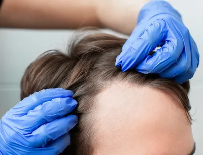 Лечение облысения у женщин при выпадении волос | Клиника HFE