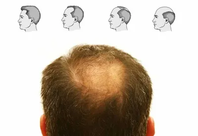 Учёные нашли связь между облысением и тяжелым течением коронавируса у мужчин  - Real Trans Hair - клиника пересадки волос и биологического омоложения