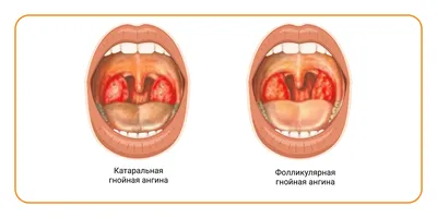 Ангина: истории из жизни, советы, новости, юмор и картинки — Все посты |  Пикабу