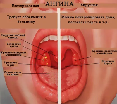 Ангина у взрослых - статьи от компании Еламед