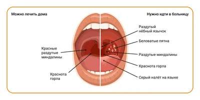 Ангина у детей и взрослых. Причины, симптомы, лечение – Семейная клиника  «Доктор АННА»