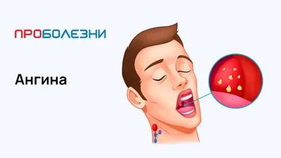Гнойная ангина, чем лечить гнойную ангину, симптомы и признаки - блог  Furasol®