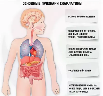 Гнойная ангина: причины, симптомы, заразна ли, осложнения, что делать при  остром тонзиллите