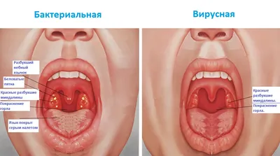 Стрептококковая ангина лечение, симптомы, инкубационный период, стрептококк  ангина — блог Furasol®