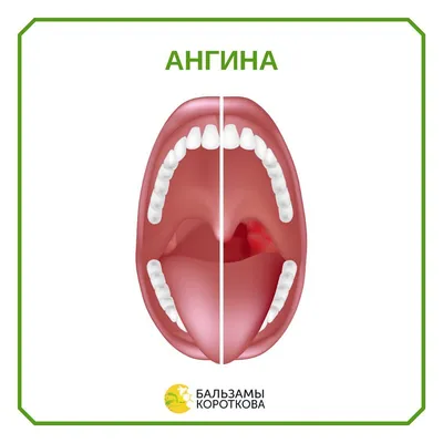 Лечение ангины в СЗАО (м.Щукинская, м.Стрешнево, м.Сокол)