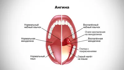 Герпетическая ангина у детей - признаки, причины, симптомы, лечение и  профилактика - iDoctor.kz