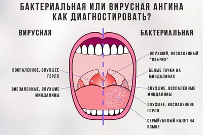 Для тех, кто умудрился заболеть или как победить Ангину | Пикабу