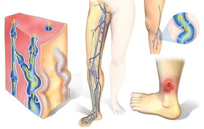 Трофические язвы на ногах: лечение и диагностика в Одессе | Медицинский дом  Odrex