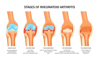 Двойной удар пациентов: артрит и разрыв мениска колена | Питтсбург Пост-Газетт