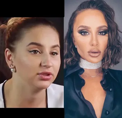 Исправила нос, грудь и попу: фото Анны Asti до и после пластики