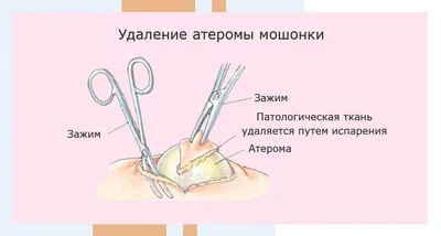 Удаление атеромы лазером в Москве | Клиника АЛОДЕРМ Москва