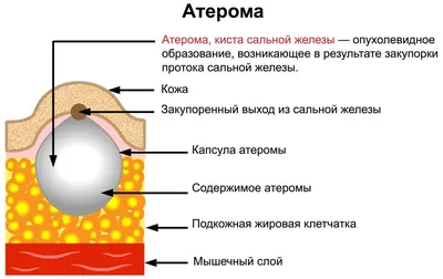 Безоперационное удаление атером лазером в Санкт-Петербурге — БИОМЕД