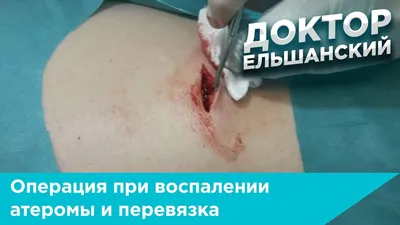 Удаление атеромы лазером и хирургически в Санкт-Петербурге