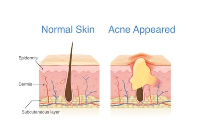 Шрам после удаления атеромы — как убрать рубец | блог Expert Clinics