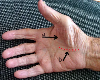 Атрофия мышц руки фото фотографии