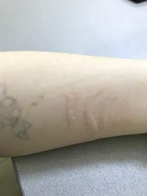 Крапивница: фото, причины, симптомы, аллергическая, как лечить
