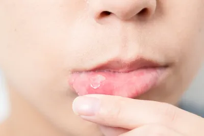 Учеными обнаружена связь между наличием бактерий в полости рта и болезнями