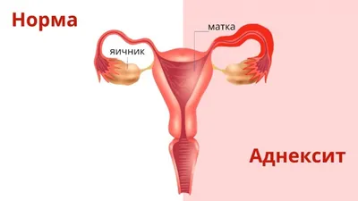 Аднексит: что это за заболевание и как его лечить