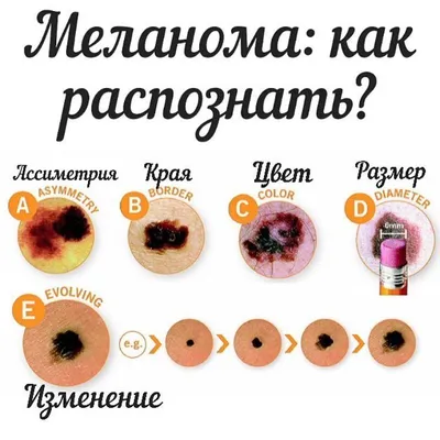 Как отличить рака кожи от меланомы и может ли родинка стать причиной рака -  24 августа 2017 - 59.ру