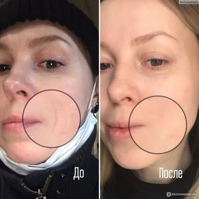 Любимая рубрика «До/После» Гармоничная коррекция губ препаратом Belotero  Intense. Благодаря способности равномерно.. | ВКонтакте