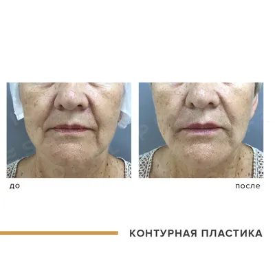 Контурная пластика Belotero в Москве: цены, фото до и после, отзывы |  Стоимость контурной пластики Belotero в клинике Seline
