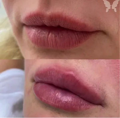 Наталья Орлова - На фото губы до и сразу после введения 1 мл Belotero  Intense💉 ⠀ Пациентка делает у меня губы уже не первый раз😊 Очень  довольна👍 ⠀ Эффект держится у неё,