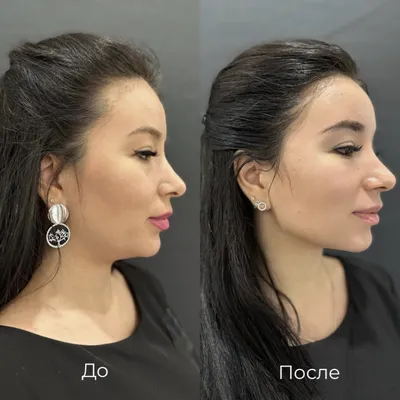 Контурная пластика препаратами Belotero®, Merz Pharma (Германия) - Art Of  Beauty - Art Of Beauty