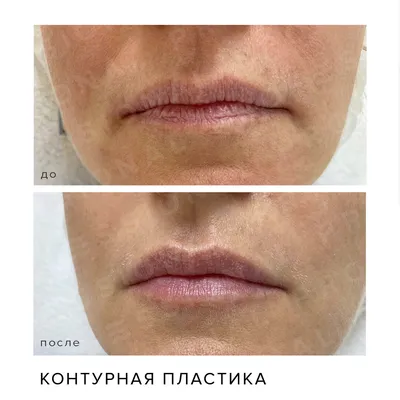 Контурная пластика Belotero - НЕТ признакам старения!