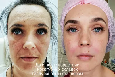 Белотеро (Belotero) - филлер для контурной пластики - процедуры препаратом  в Москве - цена, отзывы