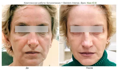 Увеличение / Аугментация губ с помощью препарата гиалуроновой кислоты -  «Увеличение губ с помощью препарата гиалуроновой кислоты Belotero Intense (Белотеро  Интенс) компании Merz Aesthetics. Фото губ до и после увеличения: на  следующий