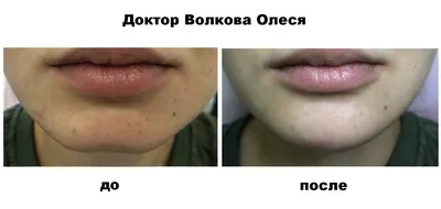 Купить Belotero Intense ✔️ Лучшая цена на филлер Белотеро Интенс.  Filler-Shop:Отзывы