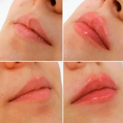 Контурная пластика препаратами Belotero®, Merz Pharma (Германия) - Art Of  Beauty - Art Of Beauty