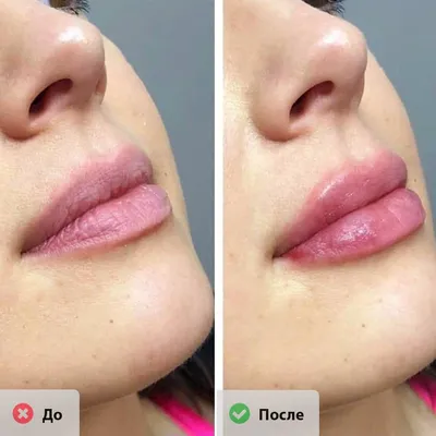 Купить Belotero Lips Contour Lidocaine ✔️ Лучшая цена на филлер Белотеро  Липс Контур | Filler-Shop: Отзывы