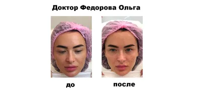 Контурная пластика препаратами Belotero®, Merz Pharma (Германия) - Art Of  Beauty - Art Of Beauty