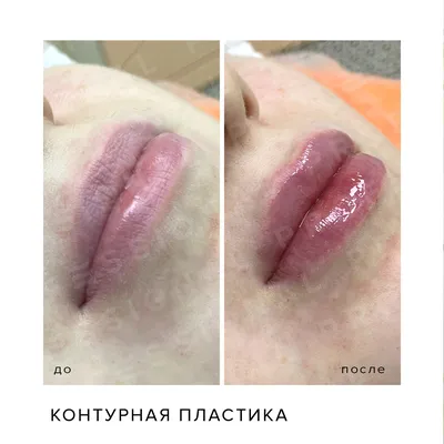 Увеличение / Аугментация губ с помощью препарата гиалуроновой кислоты -  «Увеличение губ с помощью препарата гиалуроновой кислоты Belotero Intense (Белотеро  Интенс) компании Merz Aesthetics. Фото губ до и после увеличения: на  следующий