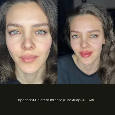 Контурная пластика Belotero - НЕТ признакам старения!