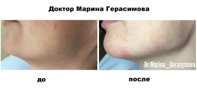 До и после - Belotero