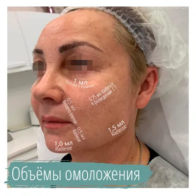 Инъекции Belotero Intense (Белотеро Интенс) - клиника лазерной косметологии  в Москве