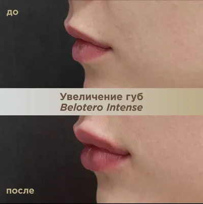 Увеличение губ гиалуроновой кислотой: цена от 9990 рублей в Москве | Уколы  в губы для увеличения в клинике BeautyWay Clinic