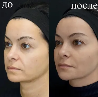 Белотеро в клинике Ирины Хрусталевой
