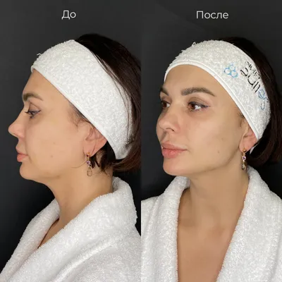 Коррекция скул – фотографии до и после