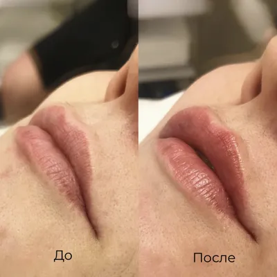 Контурная пластика лица - цена в Москве - пластика овала лица филлерами  гиалуроновой кислоты