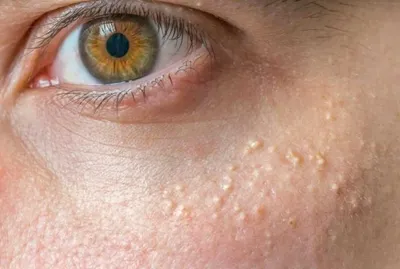 Маленькие белые точки на коже: причины и способы лечения