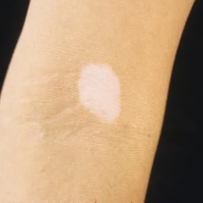 Ученые выяснили, почему «болезнь белых пятен» спасает от рака кожи -  Индикатор