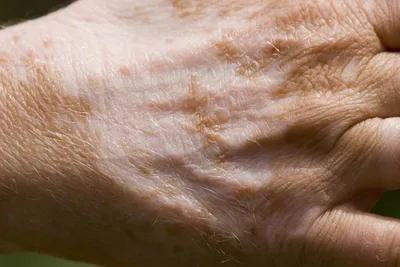 Почему появляются белые пятна на руках: как избавиться от пятен | WDAY